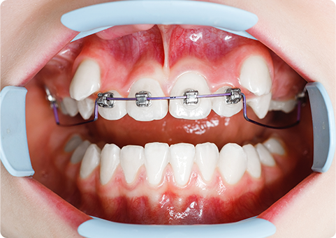 部分的に少数の歯をコントロールする、ツーバイフォーの矯正治療