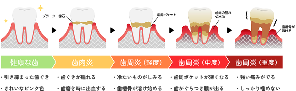 歯周病の進行 図